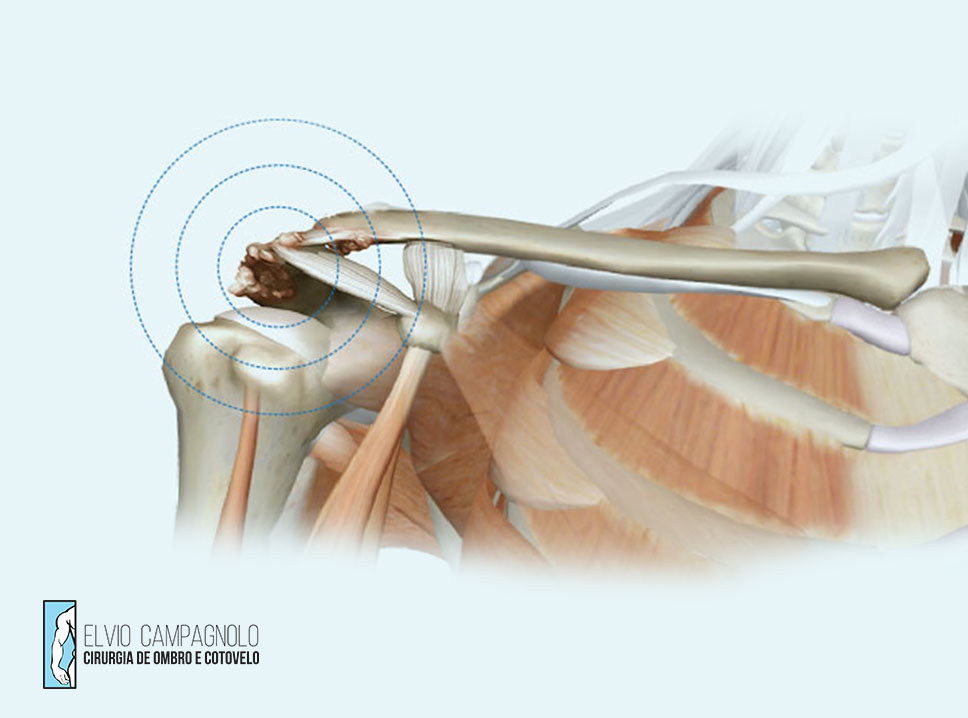 drelvioombroecotovelo-artrose-ombro